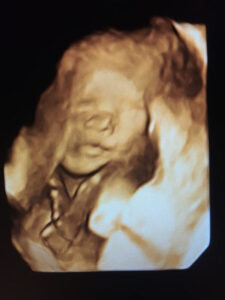 Ultrasound image of Liam