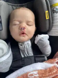 Chase - sleeping in carseat, showing nasal separator from surgery