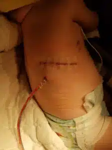 Kenzie - close up of tube in back and stitches healing