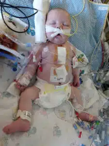 Easton - recovering in PICU bed after heart surgery