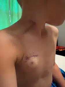 close-up of Wyatt's scars from his treatment