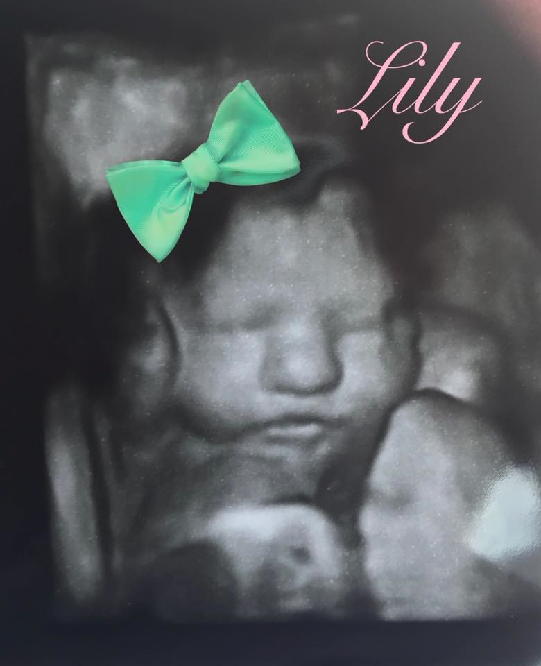 Lily Elizabeth Ward Ssm Health Cardinal Glennon Children S